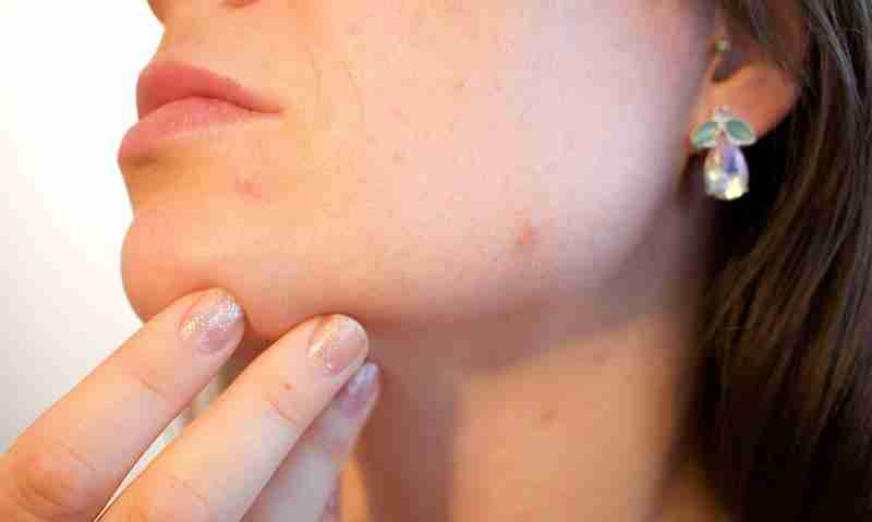 best treatment for menopausal acne